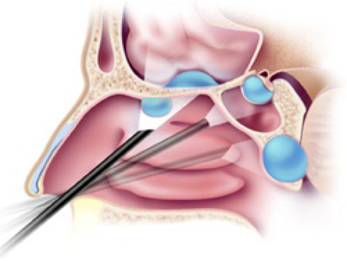 Cancer of Paranasal Sinus