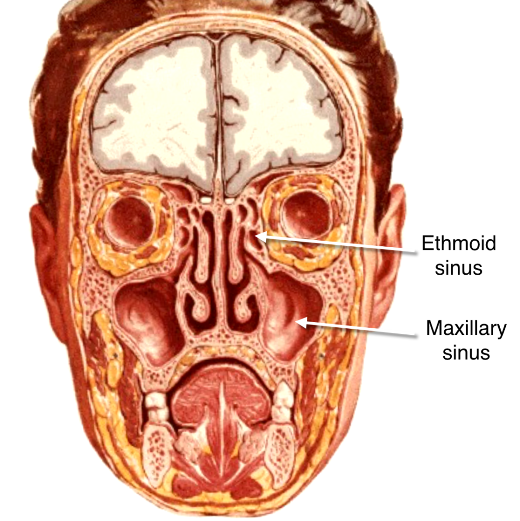 Cancer of Paranasal Sinus