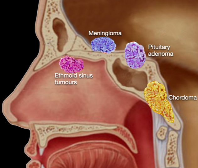 Endoscopic SkullBase Surgery