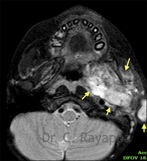 Fig.9c. Residual tumour after 6 cycles of chemotherapy. No significant response