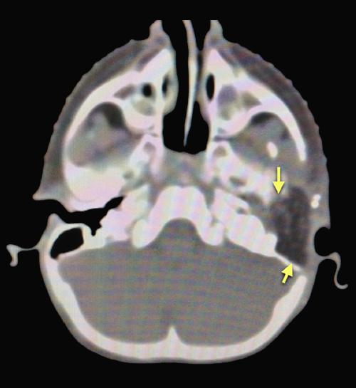 Fig.9d. CT scan after surgert shows complete resection.