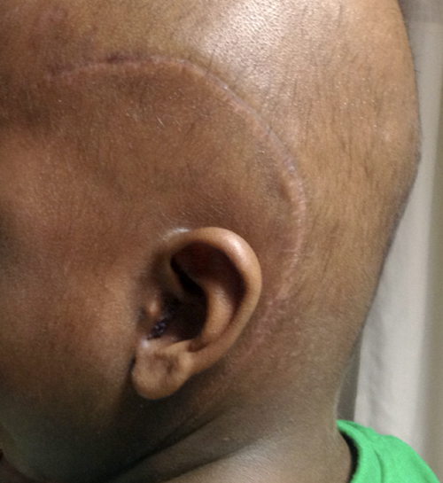 Fig.9e. Scar lies behind the hairline. will not be seen after hair growth