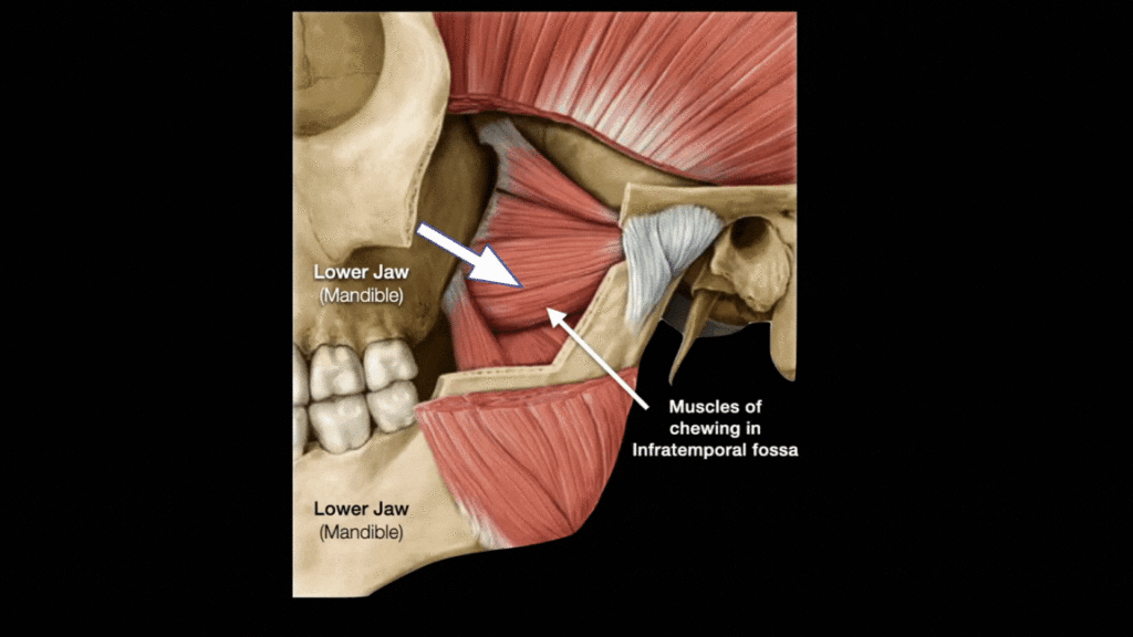 ITF-maxilla