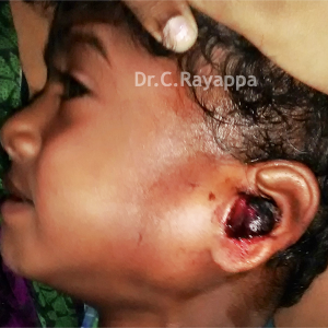 Fig.9a. 2 yrs old boy with rhabdomyosarcoma of ear