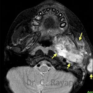 Fig.9c. Residual tumour after 6 cycles of chemotherapy. No significant response