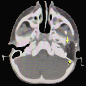 Fig.9d. CT scan after surgert shows complete resection.