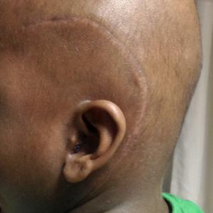 Fig.9e. Scar lies behind the hairline. will not be seen after hair growth